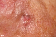 basal cell carcinoma