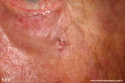 basal cell carcinoma