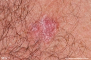 basal cell carcinoma