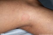 leprosy tuberculoid
