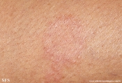 leprosy tuberculoid