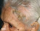 dermatosis neglecta
