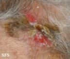 dermatosis neglecta
