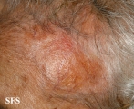 dermatosis neglecta