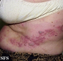 herpes zoster-varicella
