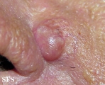 hidradenoma-nodular hidradenoma
