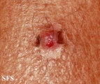 hidradenoma-nodular hidradenoma