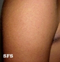 keratosis pilaris