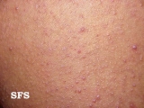 keratosis pilaris