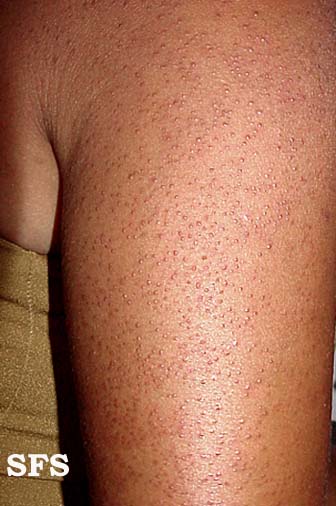 keratosis pilaris on black skin