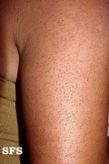 keratosis pilaris