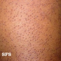 keratosis pilaris