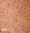 keratosis pilaris