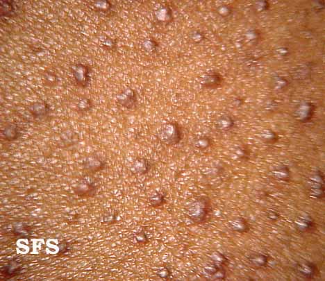 keratosis pilaris on black skin