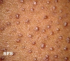 keratosis pilaris