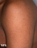 keratosis pilaris