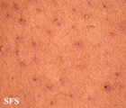 keratosis pilaris