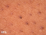 keratosis pilaris