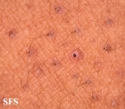 keratosis pilaris