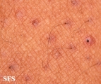 keratosis pilaris