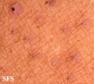 keratosis pilaris