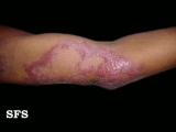 leprosy borderline