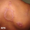 leprosy borderline