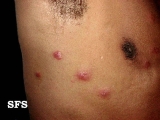 leprosy borderline