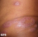 leprosy borderline
