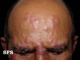 leprosy borderline