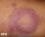 leprosy borderline
