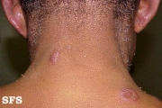 leprosy borderline
