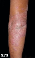 leprosy borderline