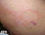 leprosy borderline
