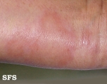 leprosy borderline
