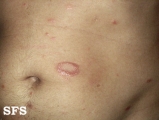 leprosy borderline