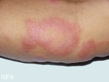leprosy borderline