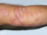 leprosy borderline