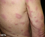 leprosy borderline