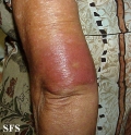 leprosy borderline