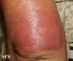 leprosy borderline