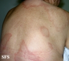 leprosy borderline