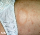 leprosy borderline