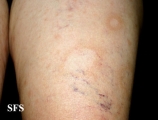 leprosy borderline