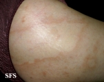 leprosy borderline