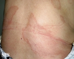 leprosy borderline