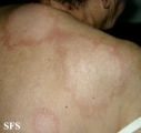 leprosy borderline
