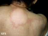 leprosy borderline