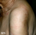leprosy borderline