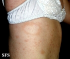 leprosy borderline